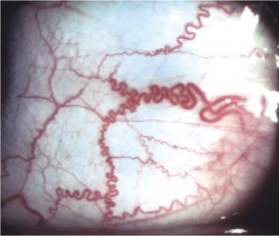 <p>What does this refer to</p><ul><li><p><u>Scleral icterus/jaundice</u></p></li><li><p><u>Pallor</u></p></li><li><p>Extremities/joints —&gt; pain</p><ul><li><p>Erythema and edema</p></li><li><p>Skeletal abnormalities</p></li></ul></li><li><p>Fundoscopic exam</p><ul><li><p>Corkscrew shaped vessels</p></li></ul></li><li><p>Precordial systolic murmur and/or cardiomegaly</p></li><li><p><u>Splenomegaly (childhood)</u></p></li><li><p>Deficit in growth parameters</p></li></ul><p></p>