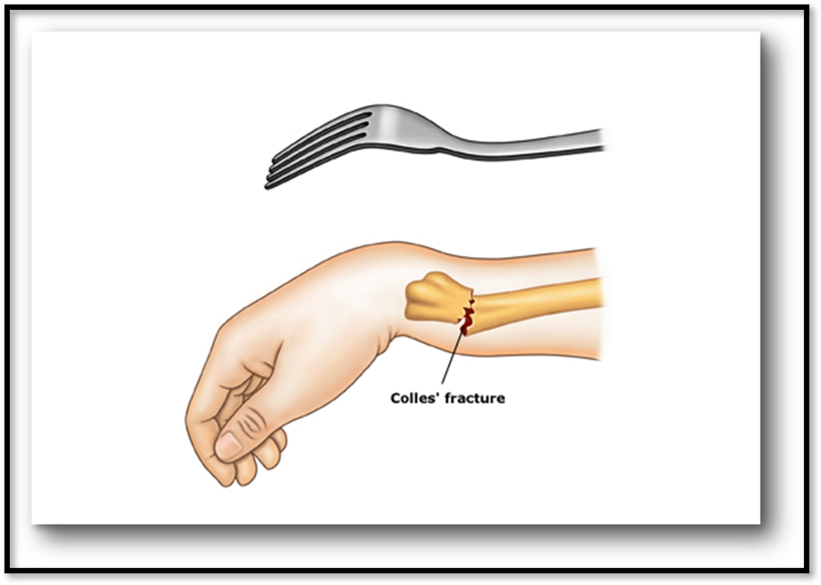 <p><span>•Common fracture of distal radius, could involve ulna</span></p><p><span>•</span><strong><u><span>Signs/Symptoms: </span></u></strong><span>Pain in area of injury, swelling, dorsal displacement of distal fragment of wrist</span></p><p><span>•</span><strong><u><span>Complications: </span></u></strong><span>Vascular insufficiency, carpal tunnel</span></p><p><span>•</span><strong><u><span>Diagnostic: </span></u></strong><span>X-ray, CT scan</span></p><p><span>•</span><strong><u><span>Treatment: </span></u></strong><span>Close manipulation using splint, cast, internal/external fixation</span></p><p><span>•</span><strong><u><span>Nursing: </span></u></strong><span>Prevent edema, active ROM</span></p>