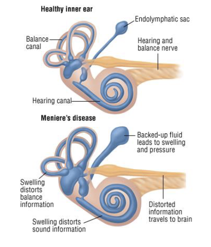 <p>Caused by:</p><ul><li><p>Excessive fluid build up in inner ear</p></li><li><p>Unknown why this occurs</p></li></ul><p>Symptoms:</p><ul><li><p>Sudden episodes of: tinnitus, hearing loss, and/or vertigo</p></li><li><p>Each episode can last minutes to hours</p></li><li><p>May occur in clusters, then subside for years</p></li></ul><p>Treatment:</p><ul><li><p>No cure; managing symptoms</p></li><li><p>Can lead to permanent hearing loss, but rare</p></li></ul><p></p>