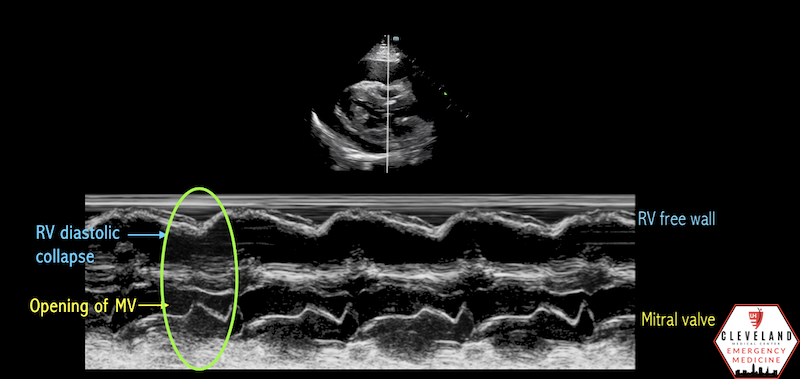 <p>What condition is seen in the following m-mode image?</p>