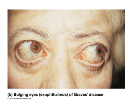 <ul><li><p>Autoimmune disease: body makes abnormal antibodies(they mimic TSH) directed against thyroid follicular cells</p></li><li><p>Antibodies mimic TSH, stimulating TH release</p></li></ul><p></p>