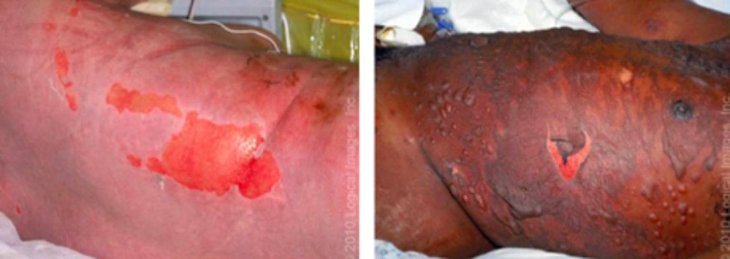 <p>Desquamation Disorders:</p><p>Overview:</p><p>- Severe mucocutaneous reaction</p><p>- Most commonly triggered by meds</p><p>- Extensive necrosis and detachment of epidermis</p><p>- Mucous membranes affected in &gt;90% pt, usually at 2+ distinct sites (ocular, oral, genital)</p>