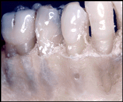 <ul><li><p>“Window” where exposed root is covered only by periosteum and gingiva, not bone</p></li></ul><p></p>