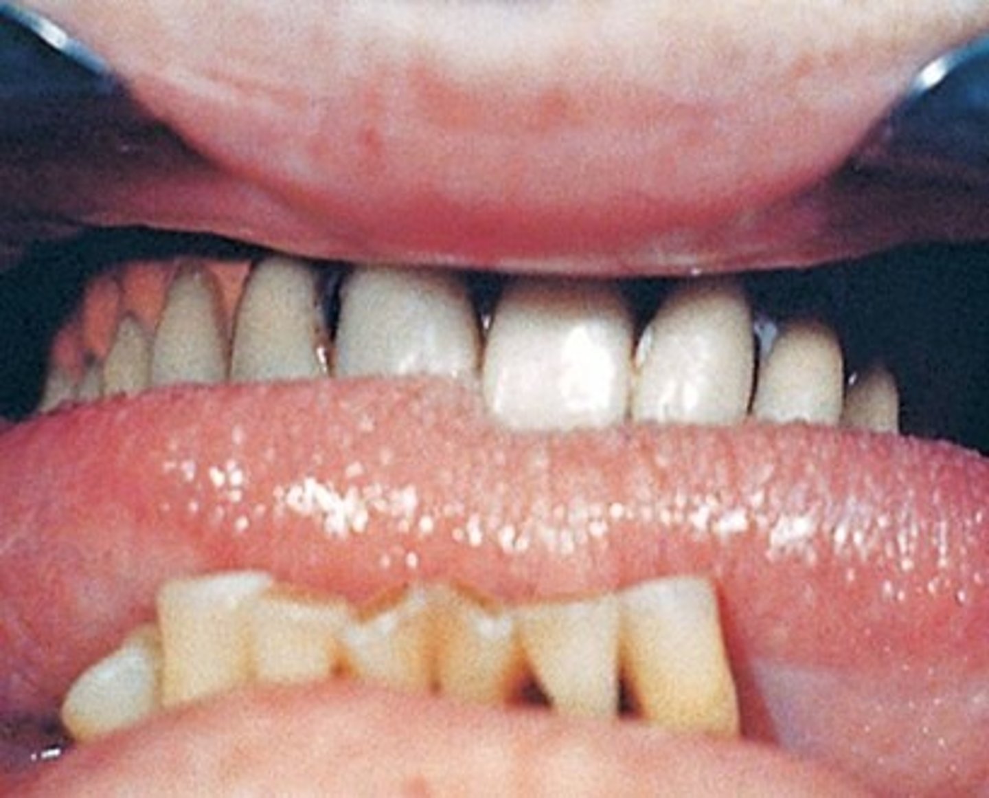 <p>-enlarged tongue</p><p>-rare condition that results when the hypersecretion of growth hormones occurs in adult like after closure of epiphyseal plates of the long bones</p>