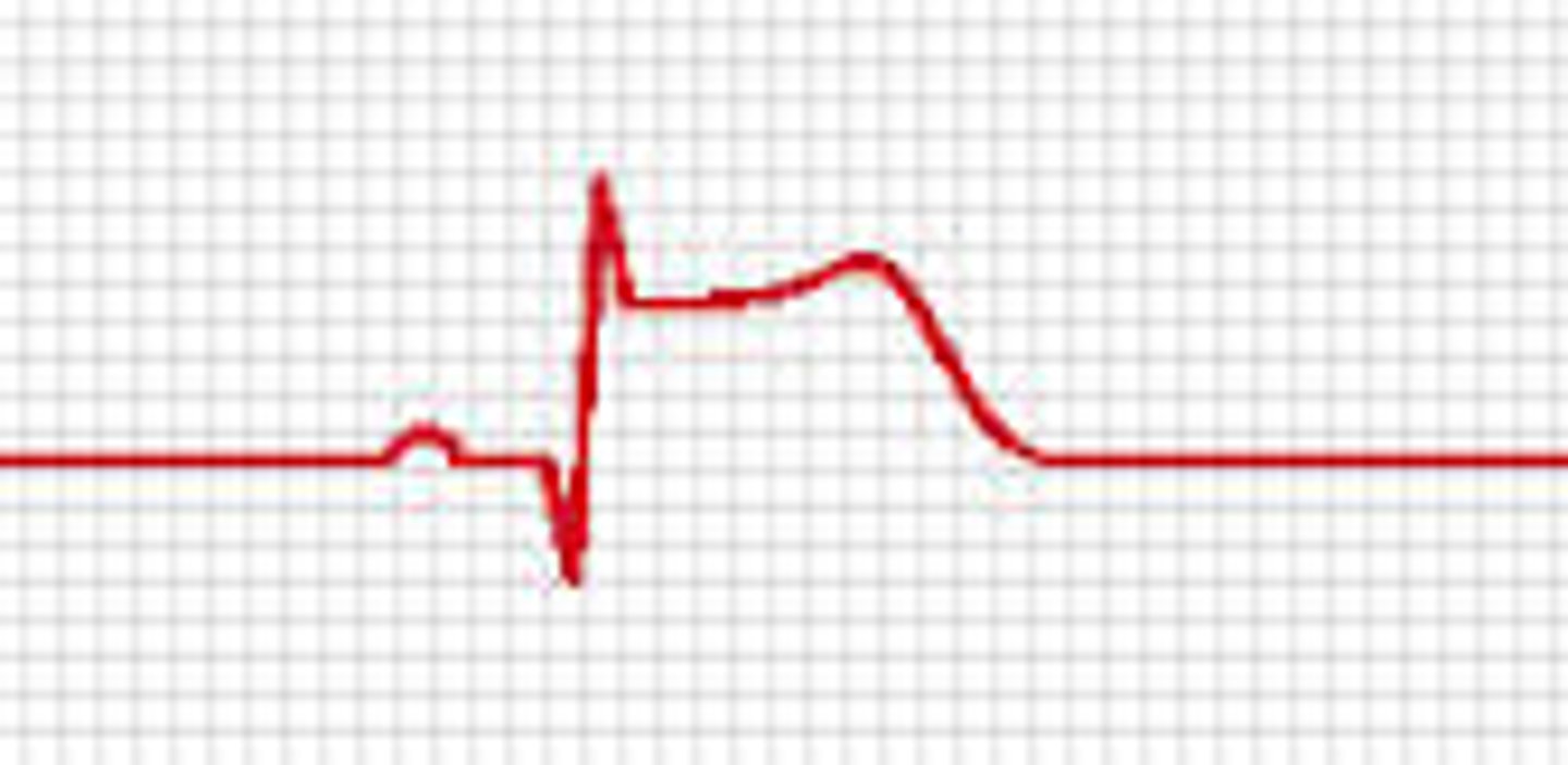 <p>-more extensive MI associated with prolonged and complete coronary occlusion (total)</p><p>-full wall thickness damage</p><p>-elevation of ST-segment on ECG</p><p>-called a ST-Segment Elevation MI (STEMI)</p>