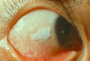 <ul><li><p>Leads to build up of Keratin Debris - common in children in developing world</p></li><li><p><span style="color: red"><strong><em><u>Bitot’s Spots </u></em></strong></span></p></li><li><p>Interpalpebral conjunctival foamy looking patches</p></li></ul><p>Can eventually lead to <strong>corneal ulceration</strong></p>