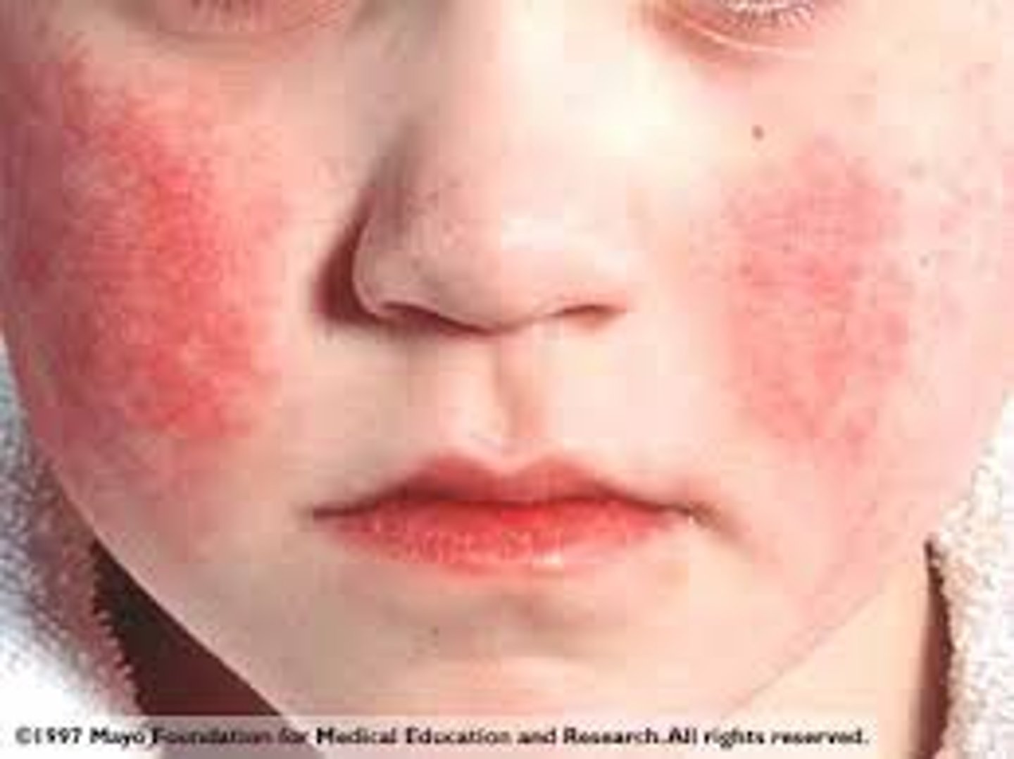 <p>when rash appears</p>