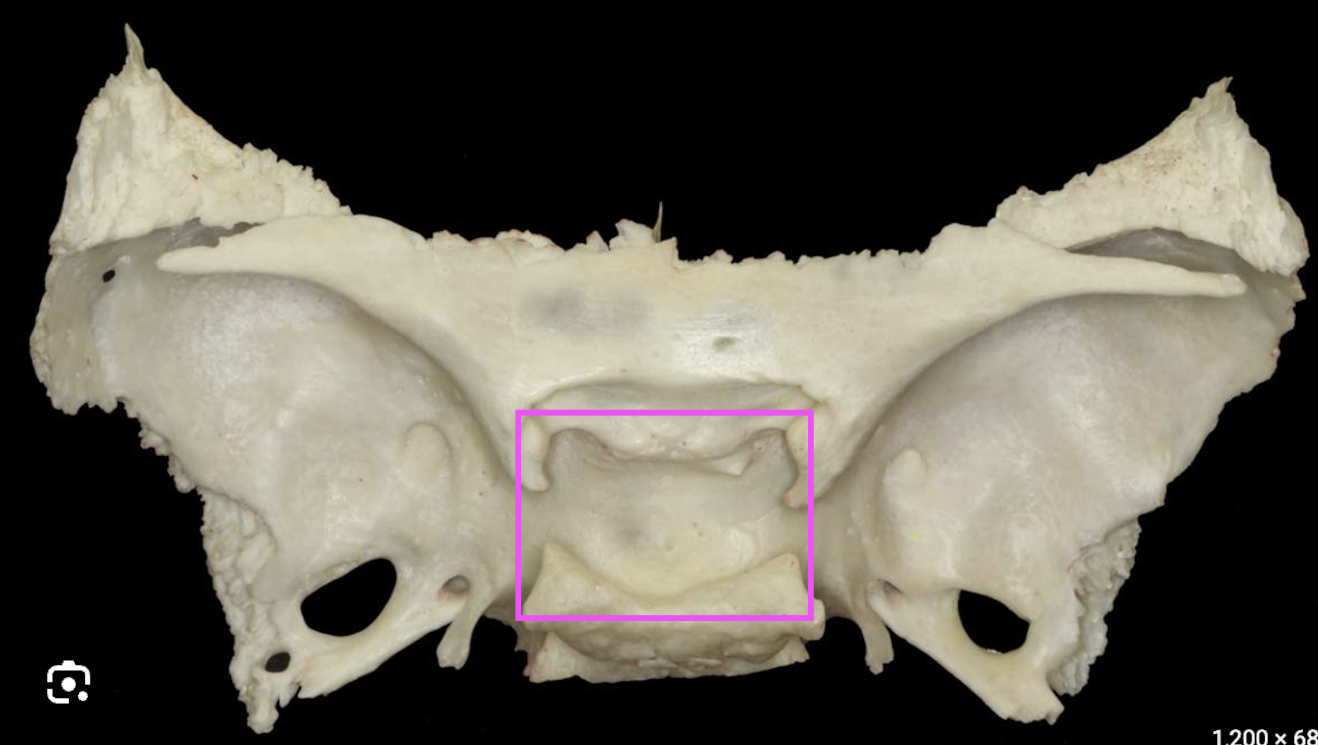<p>What bone marking is this?</p>