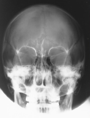 <p>What is this X-ray demonstrating?</p>