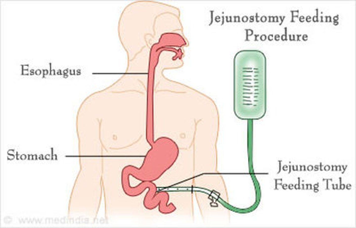 <p>J tube</p><p>NG tube has most risk FOR aspiration***</p>