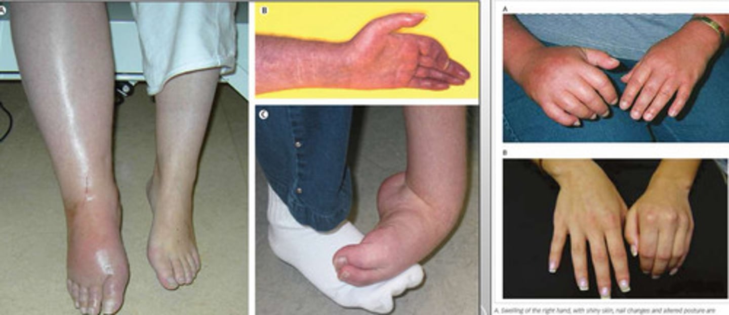 <p>• Soft tissue swelling</p><p>• Regional osteoporosis</p><p>• Rapid, early mottled/patchy appearance, later generalized, could</p><p>become bilateral</p><p>• Aggressive and severe destruction of bone</p><p>• Significant juxta-articular osteoporosis</p><p>•Could involve the entireextremity</p><p>• Radionuclide imaging (bone scan)</p><p>Are all common finding in what condition?</p>