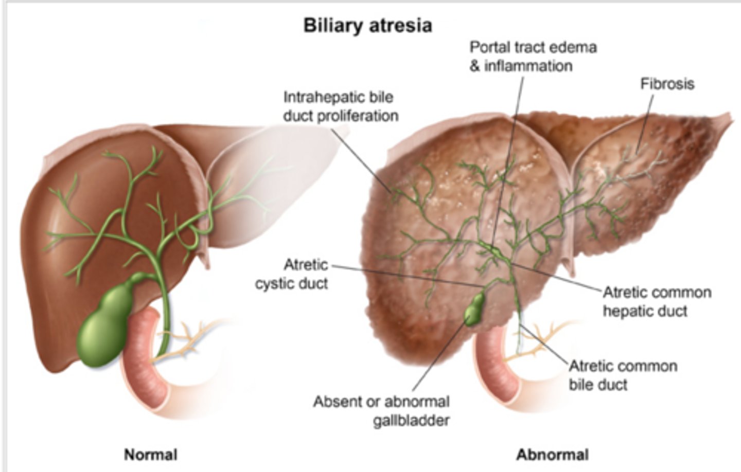 <p>Biliary atresia</p><p>- US: absent or abnormal gallbladder then hepatobiliary scintigraphy: failure tracer excretion</p><p>- tx: hepatoportoenterostomy (Kasai procedure), Liver transplant</p>
