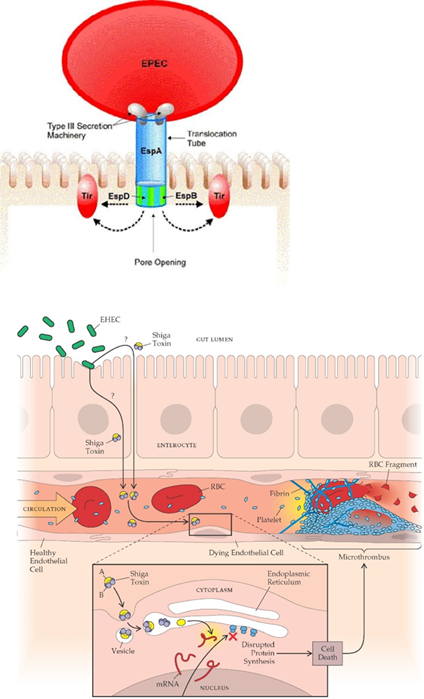 <ol><li><p>EPEC attaches to intestinal cells using <strong>BFP (bundle-forming pili)</strong> for initial contact.</p></li><li><p>Uses a <strong>Type III Secretion System</strong> to inject <strong>Tir</strong> into the host cell.</p></li><li><p><strong>Tir</strong> integrates into the host membrane and binds <strong>Intimin</strong> on EPEC, creating a stronger attachment.</p></li><li><p>Changes in actin form <strong>pedestals</strong> under the bacteria, leading to <strong>effacement (A/E lesions)</strong> and loss of microvilli.</p></li><li><p>Disrupts <strong>tight junctions</strong>, leading to fluid loss and <strong>diarrhea</strong>.</p></li><li><p>Intestinal cell death and damage to <strong>fluid absorption</strong> worsen diarrhea.</p></li></ol><p></p>