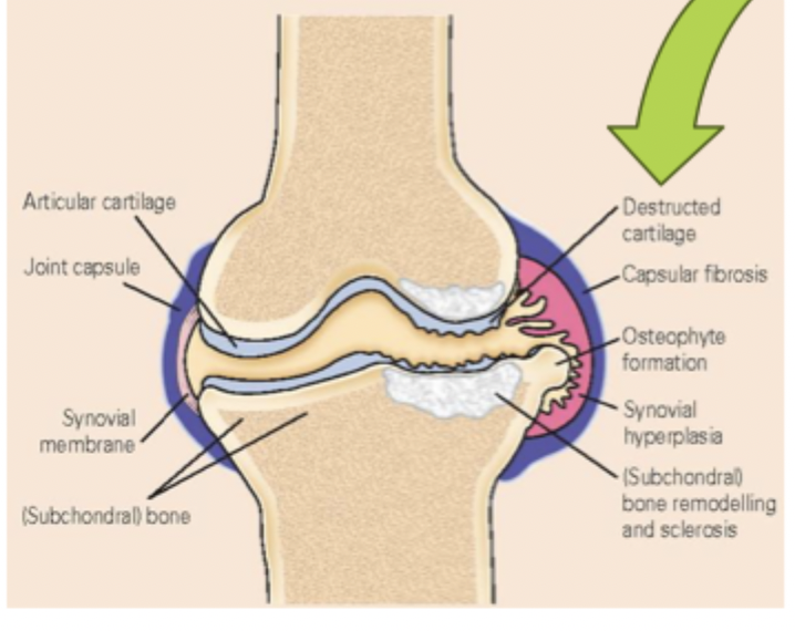 <p>Breakdown of cartilage in joint causes bone-on-bone action and may lead to </p>