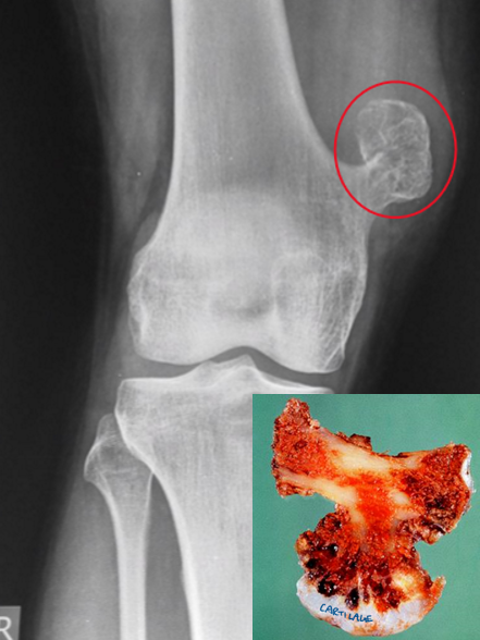 <p><strong><span style="color: red">benign outgrowth (exostosis) </span>of <span style="color: red">bone with a cartilage cap</span></strong></p><ul><li><p><strong>develop <mark data-color="blue">only in bones of endochondral origin &amp; arise from the metaphysis near the growth plate of long tubular bones → especially near the </mark><span style="color: red"><mark data-color="blue">knee</mark></span></strong></p></li><li><p>grossly seen as <strong><mark data-color="blue">mushroom-shaped outgrowths</mark></strong></p></li><li><p><strong><mark data-color="blue">only bone portion seen on X-ray</mark></strong></p></li></ul><p>risk factors</p><ul><li><p><strong><mark data-color="green">MEN affected more than women</mark></strong></p></li><li><p><strong><mark data-color="green">late adolescence &amp; early adulthood</mark></strong></p></li><li><p>may be associated with an <strong><mark data-color="green">increased risk of malignancy (5 - 20% of hereditary type)</mark></strong></p></li></ul>