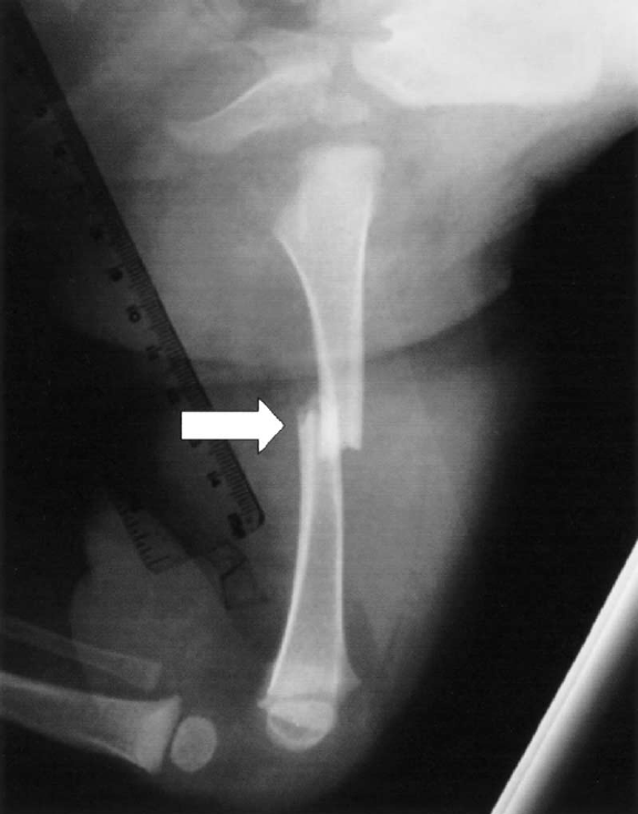 <p>Bone breaks straight across, typically at a right angle to the bones axis </p>