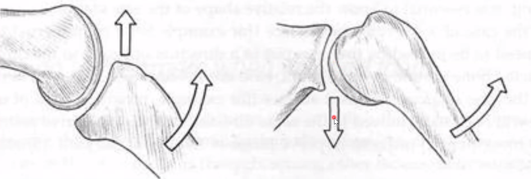 <p>Con<strong>vex moving</strong>: Roll opposite to concave, Glide opposite of shaft of long bone…</p><p>Con<strong>cave</strong>: Roll &amp; Glide same direction as the long bone…</p><p>(Type 1)</p>
