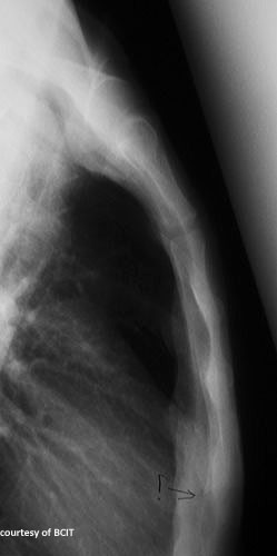<p>Where do most sternal fractures occur?</p>