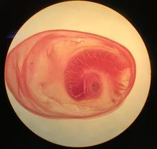 <p><strong>Identify this parasitic stage, its adult parasite, and mention the type of brain lesion it produces.</strong></p><ul><li><p><em>Cysticercus cellulosae</em></p></li><li><p>Adult parasite: <em>Taenia solium</em></p></li><li><p>Brain lesion: <strong>Cystic lesion (cysticercosis)</strong></p></li></ul><p><strong>What is the definitive diagnostic technique?</strong></p><ul><li><p><strong>Excision biopsy</strong></p></li></ul><p><strong>Mention two morphological characteristics of this stage.</strong></p><ul><li><p>About <strong>5 × 10 mm</strong>, bladder-like (contains fluid)</p></li><li><p><strong>Scolex invaginated</strong> with 4 suckers and double rows of hooks</p></li></ul><p></p>