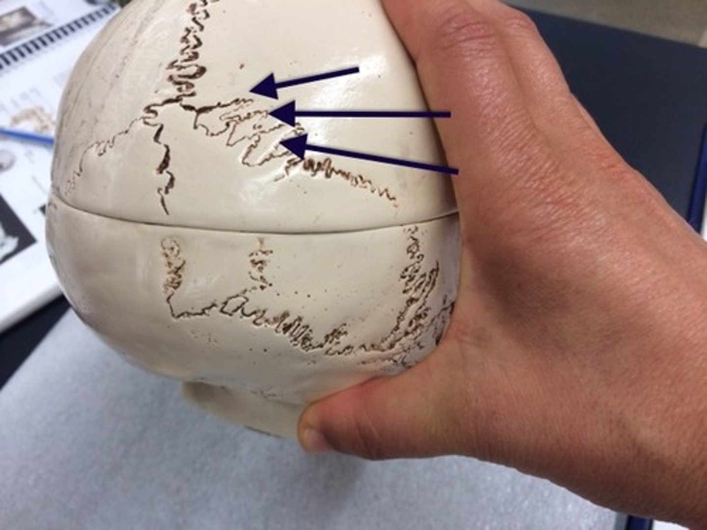 <p>Extra bones in cranial sutures.</p>