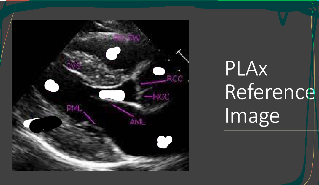 <p>what are the white labels</p><p>RV</p><p>LA</p><p>LV</p><p>LVOT</p><p>AO</p>