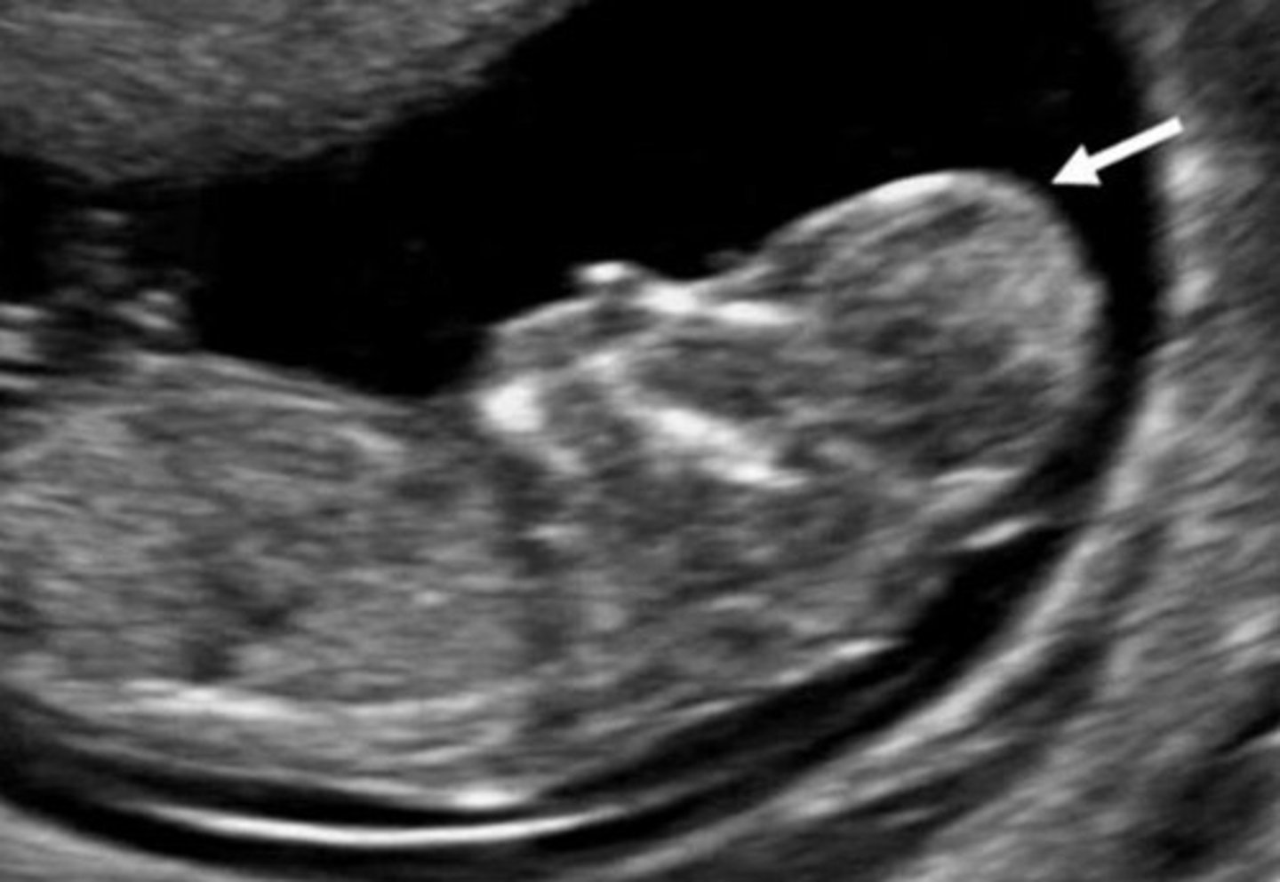 <p>Partial or complete absence of cranium</p><p>May degenerate to anencephaly</p><p>Lethal</p>