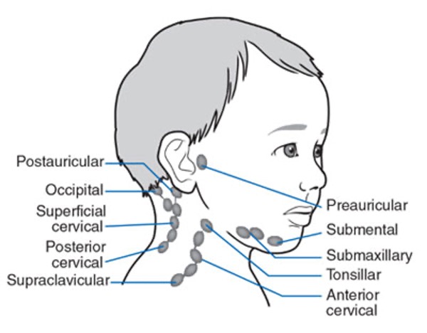 <p>common soft tissue infection in children; fever, localized swelling and redness on lymph node; localized pain</p>