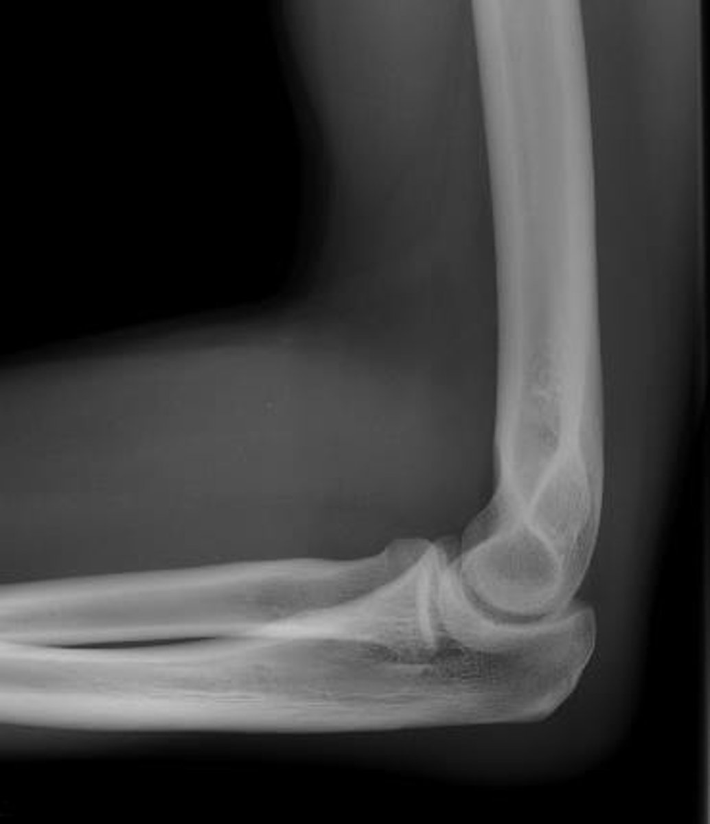 <p>Example of an articulation involving the Humerus and Ulna, and Humerus and Radius.</p>