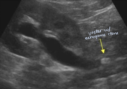 <ul><li><p>short for <em><mark data-color="yellow" style="background-color: yellow; color: inherit;">ureteropelvic junction</mark></em></p></li><li><p><mark data-color="yellow" style="background-color: yellow; color: inherit;">near kidneys</mark></p></li></ul><p></p>