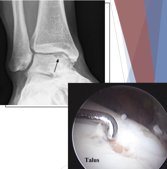 <p>Ankle Sprain Complications</p>