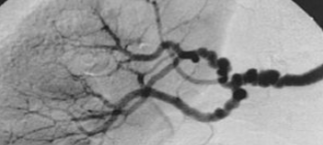 <ol><li><p>The appearance of these vessels are similar to what?&nbsp;</p></li><li><p>What is the name of this pathology if renal artery stenosis is secondary to it?&nbsp;</p></li></ol><p></p>