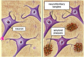 <p><strong>Alzheimer’s Disease: Pathophysiology, Pt. 2</strong></p><p>-________ and tangles damage and destroy nerve cells </p><ul><li><p>Plaques are deposits of a protein fragment called ____-______, which is a byproduct of ___ degradation.</p></li><li><p>Builds up in the space ________ nerve cells, creating issues with neuron to neuron __________</p></li><li><p>Builds up around brain vessels (amyloid _______)</p></li></ul><p>-Tangles are twisted _______ of a protein called ___</p><ul><li><p>Builds up ______ cells</p></li><li><p>Poor signaling within neuron → __________, for the neuron cannot compensate </p></li></ul><p></p>