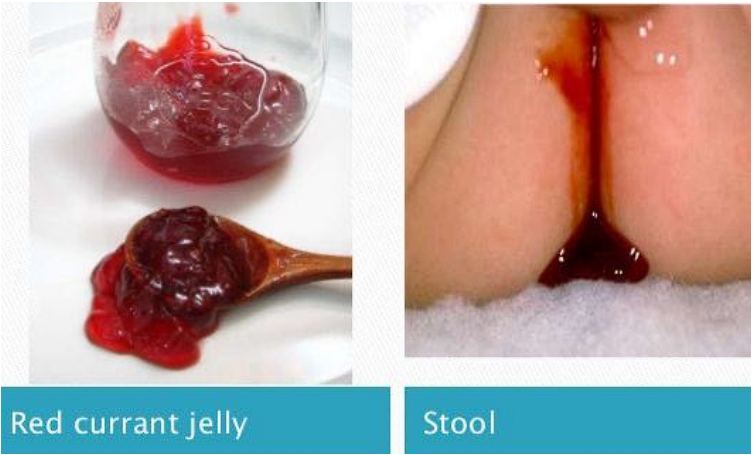 ● Red currant jelly  stools 

● Cyclical abdominal  pain 

● Nausea 

● Vomiting 

● Green, bilious emesis 

● Sausage-shaped mass  in abdomen  