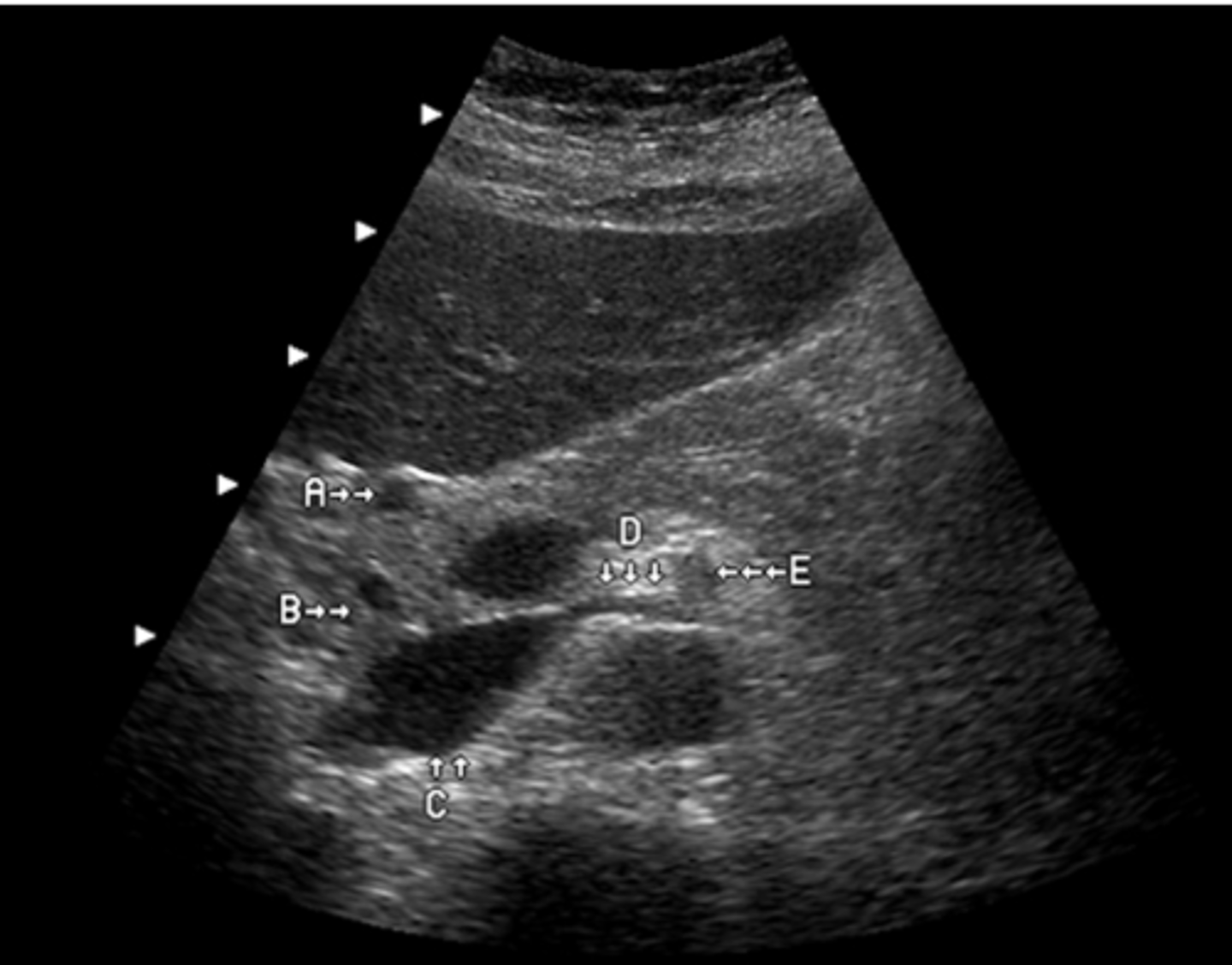 <p>Identify the anatomy labeled "C"</p><p>a. aorta</p><p>b. portal vein</p><p>c. superior mesenteric vein</p><p>d. inferior mesenteric vein</p><p>e. Inferior vena cava</p>