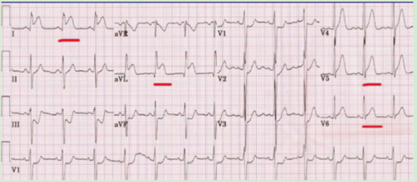 <p>ST elevations in leads I, aVL, V5, V6</p>