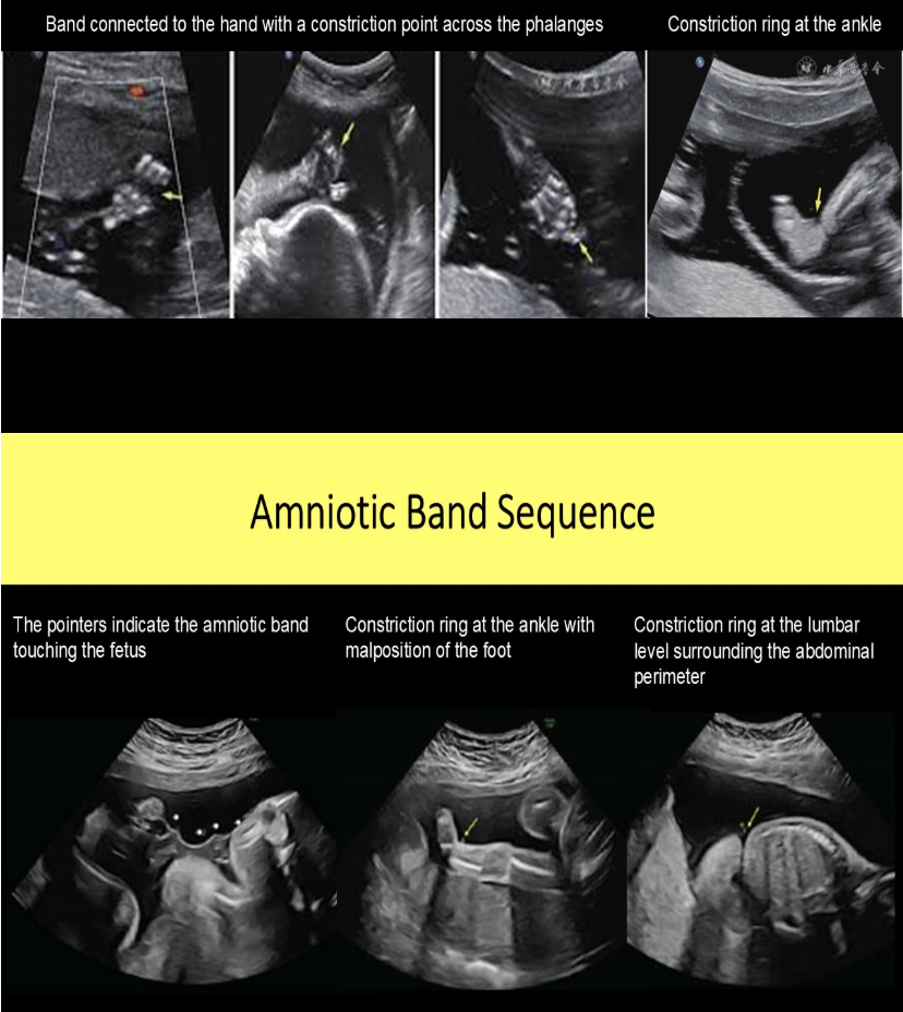 <p>a) amniotic band sequence</p>