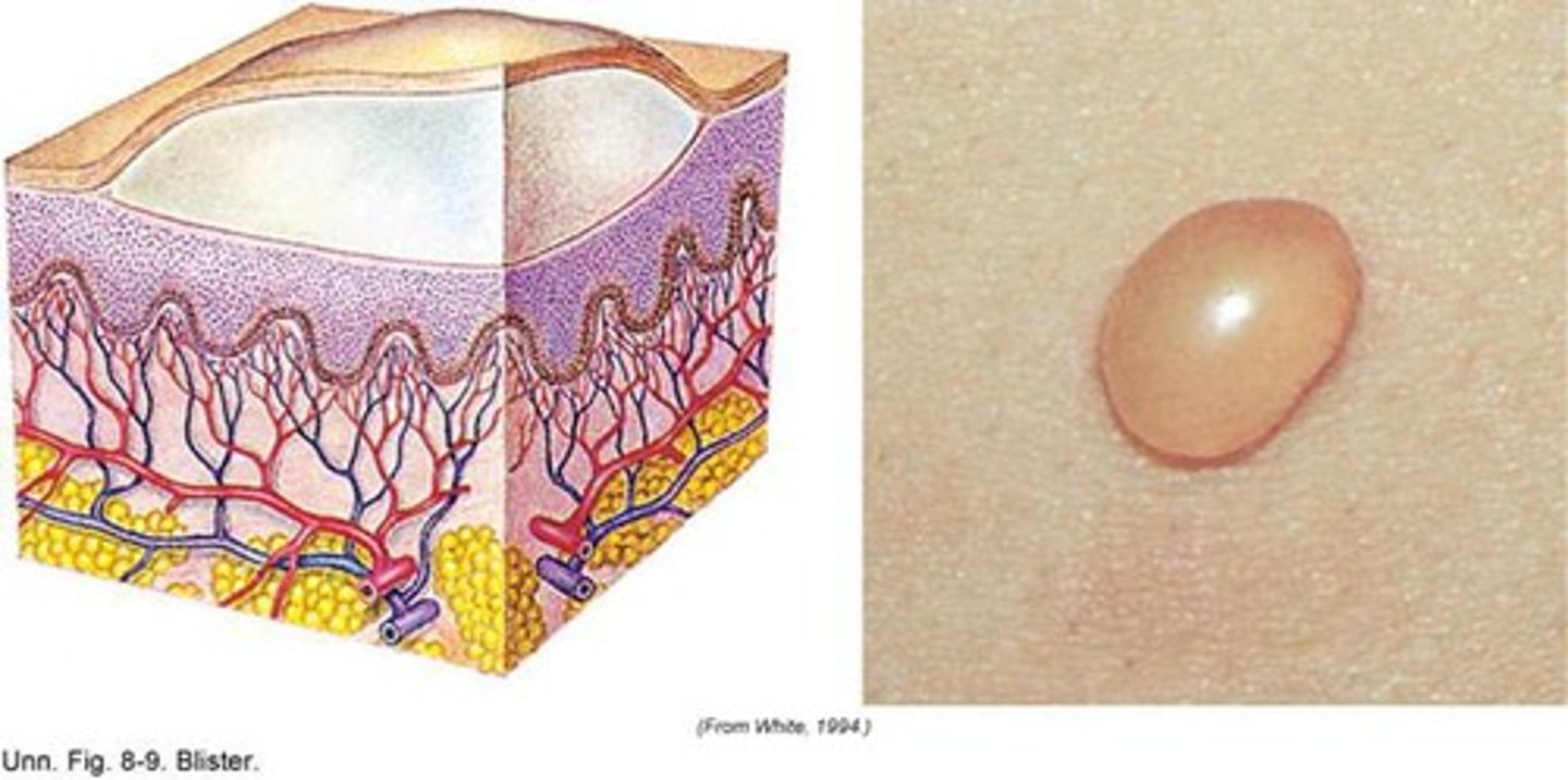 <p>-circumscribed elevated lesion</p><p>-5mm or more in diameter</p><p>-usually contains serous fluid (looks like a blister)</p>