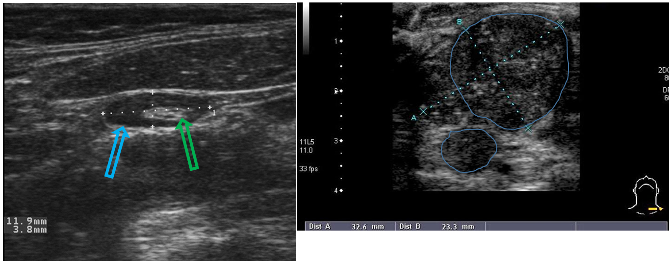 <p>Patient history: right image – palpable left supraclavicular mass in a middle-aged patient with pancreatic adenocarcinoma (left panel – asymptomatic) </p><p>Modality: ultrasound, linear high frequency transducer (7,5-12 MHz) </p><p>Region: superficial neck soft tissues</p><p> Radiologic sign: structure), larger than 3 cm left image – lymph node with normal size and morphology (hyperechoic, fatty hilum and - green arrow; hypoechoic cortex - blue arrow), short diameter is less than 10 mm; right image – enlarged lymph node conglomerate with pathologic appearance (hypoechoic, round, loss of hilar </p><p>Diagnosis: normal (left) and metastatic (right) lymph nodes (later proven to be a metastasis from pancreatic adenocarcinoma)</p>