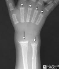 <p>is a systemic disease of infancy and childhood that is the equivalent of osteomalacia in adults. Calcification of growing skeletal elements is defective because of a deficiency of vitamin D in the diet or a lack of exposure to ultraviolet radiation (sunshine), which converts sterols in the skin into vitamin D</p>