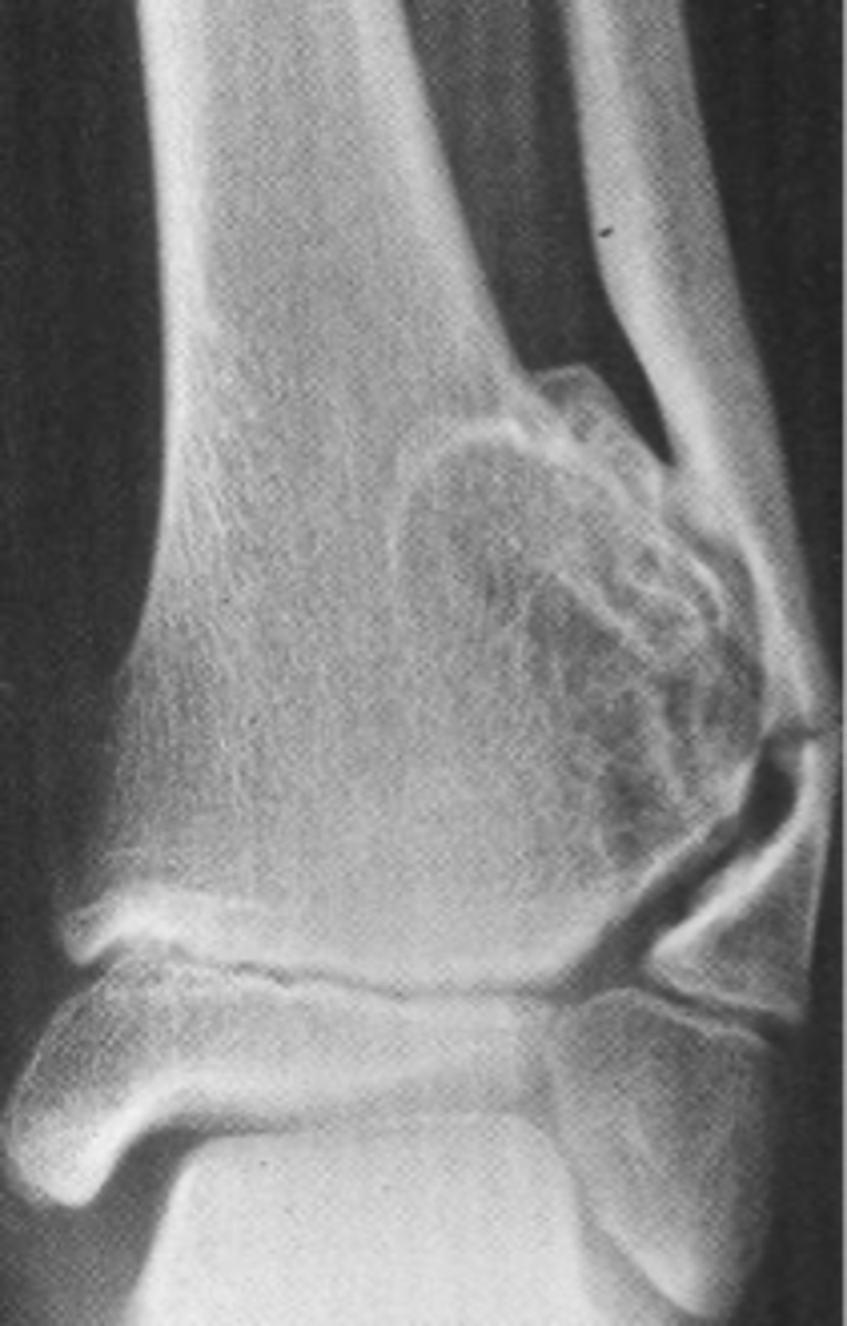 <p>_____ solitary osteochondroma:</p><p>- Broad-based</p><p>- Metaphyseal</p><p>- Wide, broad metaphysis</p><p>- Lucent when en face (on end)</p><p>- Cartilage cap uncommon</p>