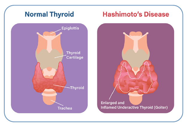 <p>Hashimoto disease or chronic autoimmune thyroiditis</p>