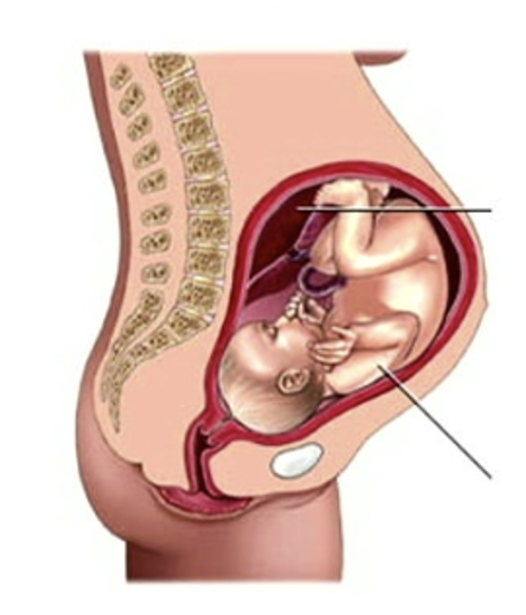 <p>excess placental production of vasopressinase = increased breakdown of ADH</p><p>causes: diseases of pregnancy including pre-eclampsia</p><p>treatments: ADH V2 R analogs, drugs to stimulate ADH secretion</p>