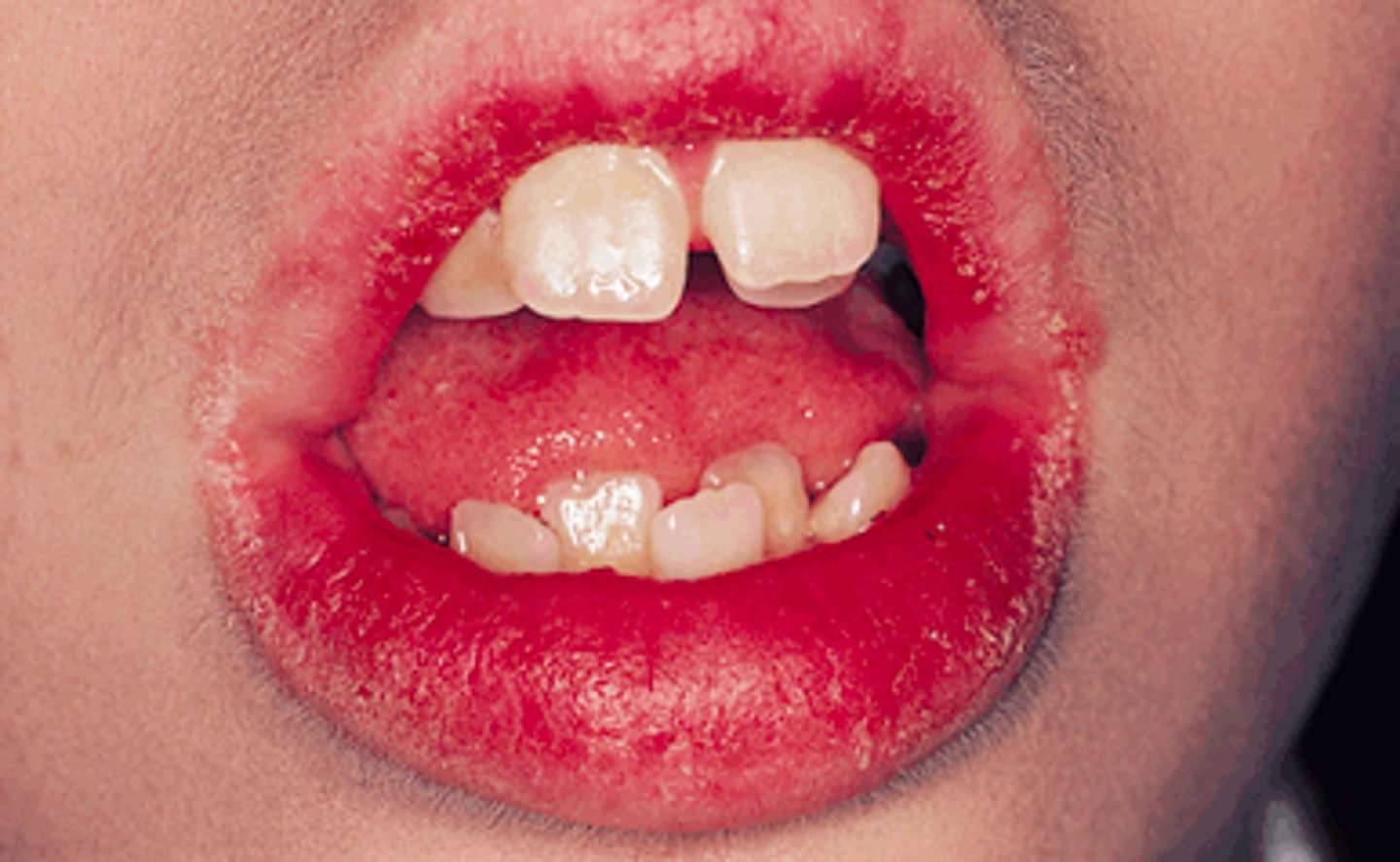 <p>patient presents with the following. They also present with other nutritional deficits. Only the mucosal part of the are effected. What is the diagnosis?</p>