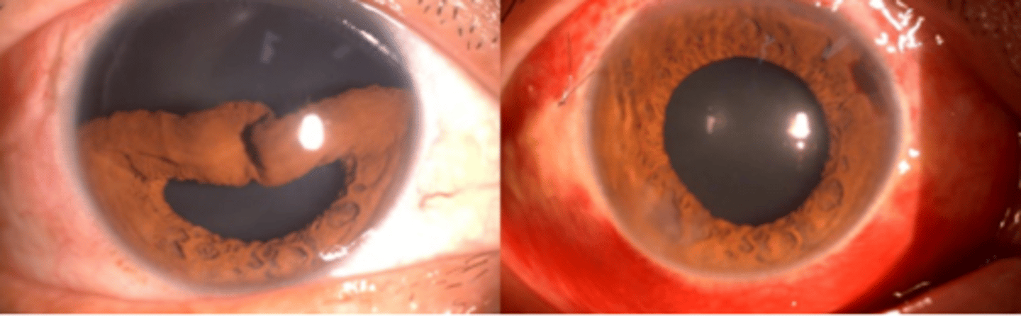 <p>tear of the iris at the iris root. Blunt force trauma or penetrating injuries pose a risk. Can result in misshapen pupil, hyphema, damage to the angle, and traumatic iritis. Symptoms include glare, photophobia, diplopia, and cosmesis. Complications include lens dislocation, cataract, and secondary glaucoma.</p>