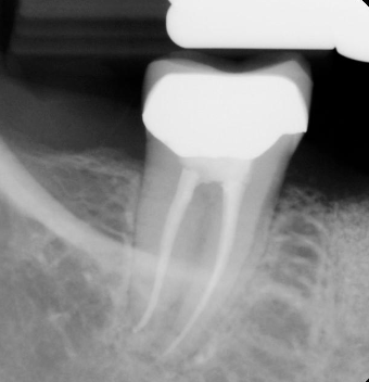 <p>What are the steps for ridge preservation follow-up?</p>