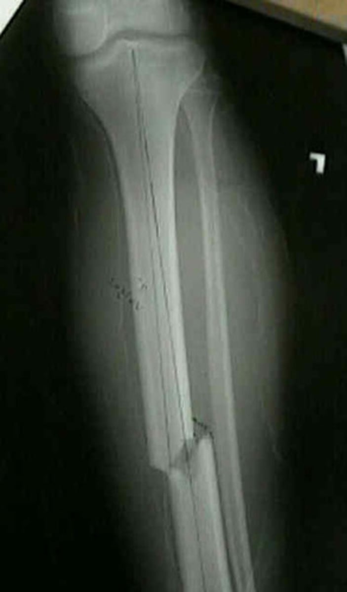 <p>complete fracture that is straight across the bone at right angles to the long axis of the bone</p>
