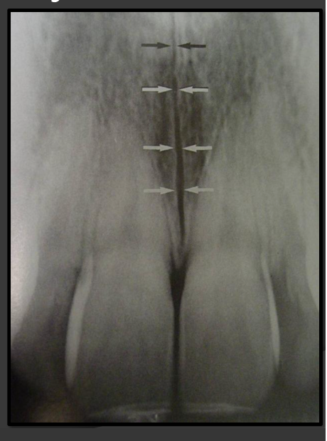 <p>A thin radiolucent line that runs directly between the maxillary incisors.</p>