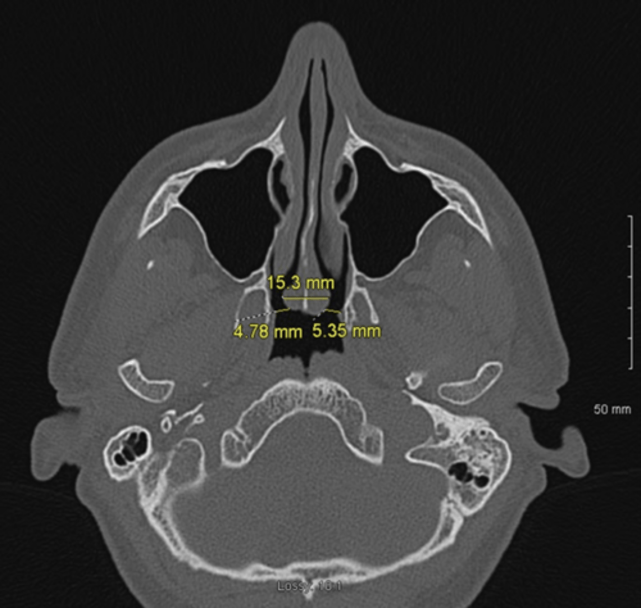 <p>axial</p>