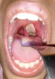 <p>pseudomembrane over tonsil area→gray exudate<br>-uvula<br>-pharynx<br>-tongue</p><p>dull red throat</p><p>caused by corynebacterium diptheriae</p><p>concern→airway compromise</p>