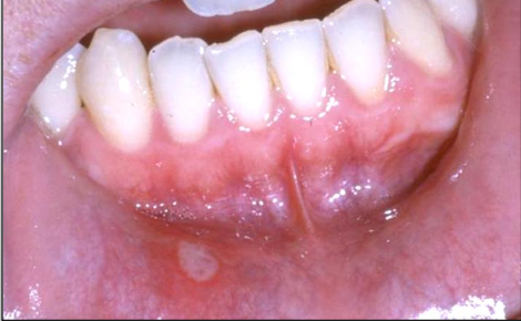 <p>Size: 3-10mm (small)</p><p>Healing time: 7-10 days</p><p>No scarring</p><p>1-5 lesions</p><p>Short duration</p><p>Few recurrences</p>